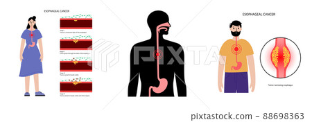 Esophageal carcinoma concept Esophageal carcinoma concept 88698363