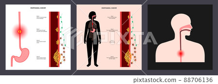 Esophageal carcinoma concept 88706136