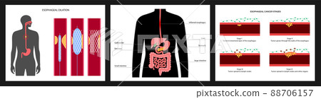 Esophageal carcinoma concept 88706157