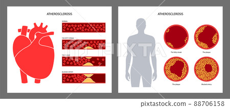 Cholesterol heart disease 88706158