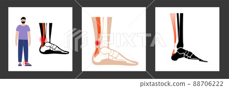 Achilles tendon injury Achilles tendon injury 88706222