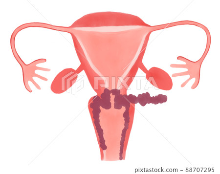 Stage and progression of cervical cancer (stage... - Stock Illustration ...