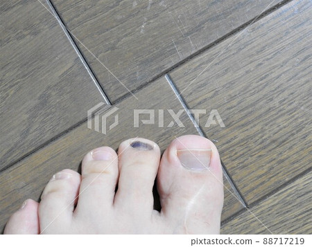 Internal bleeding toenail Internal bleeding nail Left foot 88717219