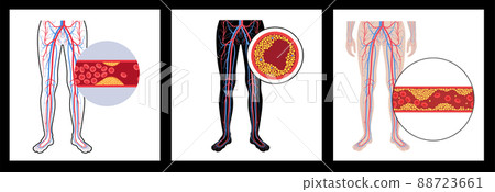 Peripheral artery disease 88723661