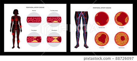 Peripheral artery disease 88726097