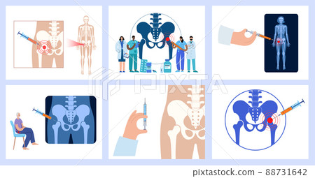 Hip joint injection Hip joint injection 88731642