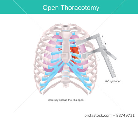 Open Thoracotomy. A procedure to gain access into the pleural space of the human chest by medical tool called Rib spreader. . 88749731