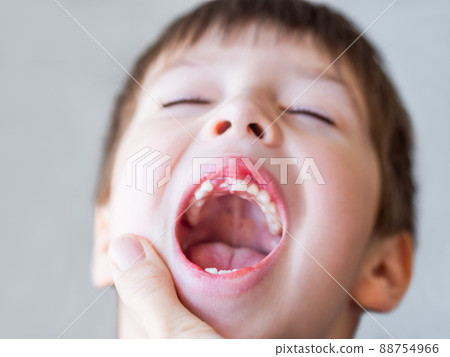 Kid shows hole in row of teeth in his mouth. One incisor fell out just now. Close up photo of gums for dentist. 88754966