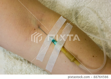 Woman's hand with catheter for dropper, butterfly needle used to draw blood from a vein or to deliver intravenous therapy to vein. Thin needle, flexible transparent tubing. Patient in nmedical clinic. Woman's hand with catheter for dropper, butterfly needle used to draw blood from a vein or to deliver intravenous therapy to vein. Thin needle, flexible transparent tubing. Patient in nmedical clinic. 88764566