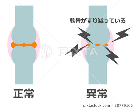 Illustration of normal bones and abnormal and painful joints Illustration of normal bones and abnormal and painful joints 88779166