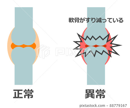 Illustration of normal bones and abnormal and painful joints 88779167