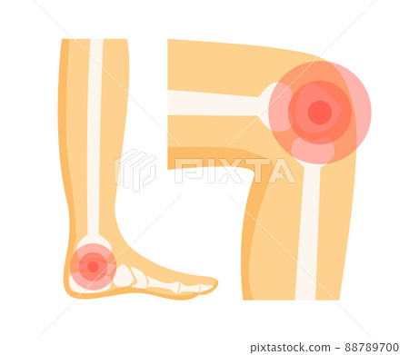 Orthopedic Problems in Foot Vector Illustration 88789700