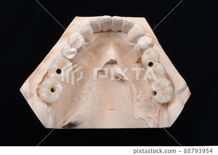 Plaster lower jaw model with zirconia teeth on implants. Process of manufacturing ceramic teeth on implants. Plaster lower jaw model with zirconia teeth on implants. Process of manufacturing ceramic teeth on implants. 88793954