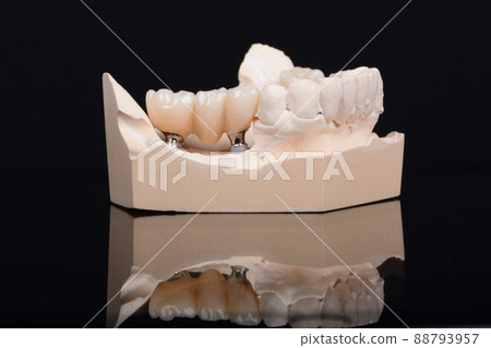 Plaster lower jaw model with zirconia teeth on implants. Process of manufacturing ceramic teeth on implants. 88793957