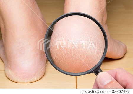 腳跟角蛋白特寫 88807982