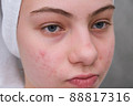 teenage girl twisted her facewith acne. 88817316