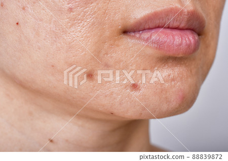 Facial skin problem, Acne disease in adult, Close up woman face with whitehead pimples 88839872