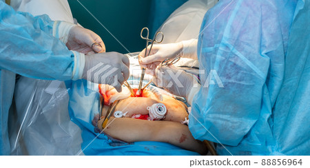 Surgical instruments in the hands of doctors during the operation. Surgical instruments in the hands of doctors during the operation. 88856964