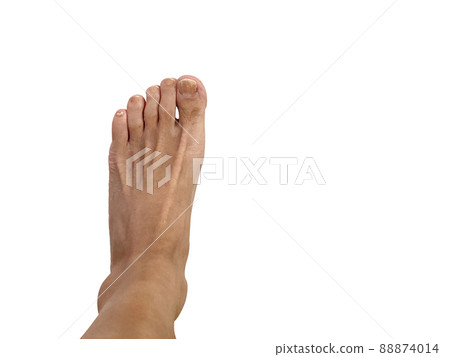 赤腳，趾甲真菌，蝨子 88874014