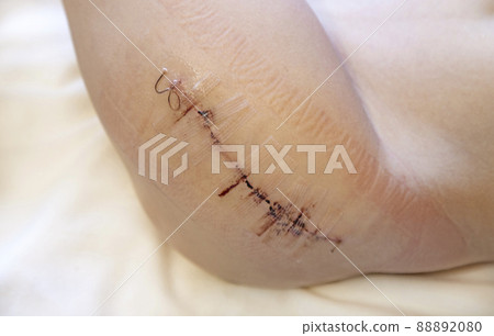 scar from surgery on a child's leg with black fiber. Hip surgery. 88892080