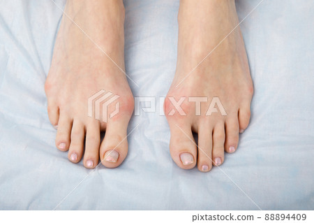 The woman suffers from inflammation of the big toe bone. Hallux valgus, bunion in foot on white background. 88894409