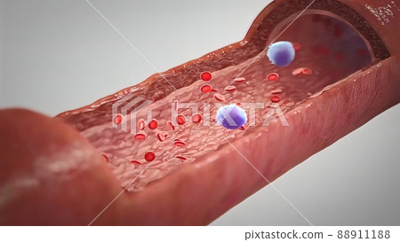 Clogged Artery with platelets and cholesterol plaque, concept for health risk for obesity Clogged Artery with platelets and cholesterol plaque, concept for health risk for obesity 88911188