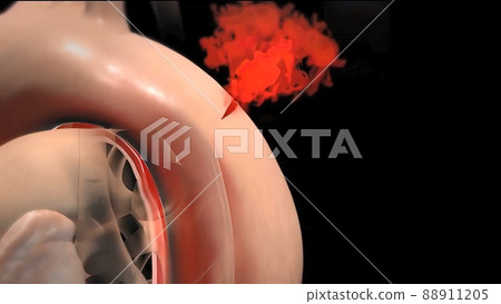 It may affect the left ventricle, aorta, aortic valve, or mitral valve. 88911205