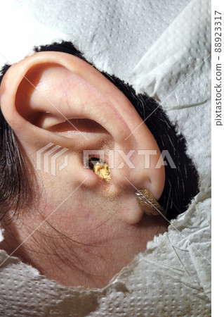 Human ear with yellow gray inside, clogged ear canal, close-up Human ear with yellow gray inside, clogged ear canal, close-up 88923317