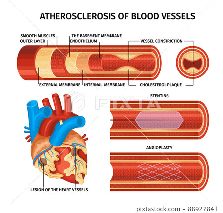 Realistic Atherosclerosis Infographic 88927841