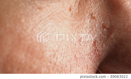Wart skin removal. Macro shot of warts near eye on face. Papilloma on skin around eye nose and neck. Birthmark Papilla or mole on skin. small hard. benign growth on the skin caused by virus. Skincare Wart skin removal. Macro shot of warts near eye on face. Papilloma on skin around eye nose and neck. Birthmark Papilla or mole on skin. small hard. benign growth on the skin caused by virus. Skincare 89063022