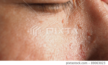 Wart skin removal. Macro shot of warts near eye on face. Papilloma on skin around eye nose and neck. Birthmark Papilla or mole on skin. small hard. benign growth on the skin caused by virus. Skincare 89063023