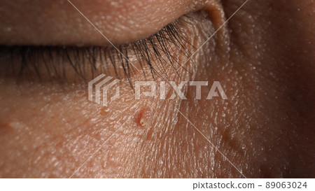 Wart skin removal. Macro shot of warts near eye on face. Papilloma on skin around eye nose and neck. Birthmark Papilla or mole on skin. small hard. benign growth on the skin caused by virus. Skincare Wart skin removal. Macro shot of warts near eye on face. Papilloma on skin around eye nose and neck. Birthmark Papilla or mole on skin. small hard. benign growth on the skin caused by virus. Skincare 89063024