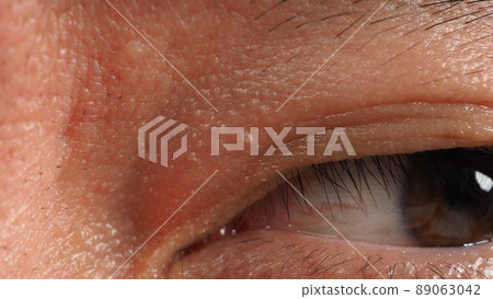 Wart skin removal. Macro shot of warts near eye on face. Papilloma on skin around eye nose and neck. Birthmark Papilla or mole on skin. small hard. benign growth on the skin caused by virus. Skincare 89063042