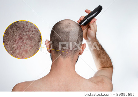The concept of baldness and baldness. A man holds a hair clipper and shaves the hair on top of his head. A shaved strip of hair shows psoriasis. Rear view The concept of baldness and baldness. A man holds a hair clipper and shaves the hair on top of his head. A shaved strip of hair shows psoriasis. Rear view 89093695