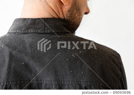 Close up view of man's shoulders in black shirt covered with dander. Back view. Copy space. The concept of psoriasis, dandruff and seborrheic dermatitis Close up view of man's shoulders in black shirt covered with dander. Back view. Copy space. The concept of psoriasis, dandruff and seborrheic dermatitis 89093696