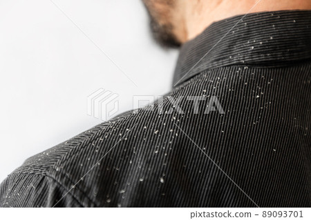 A bearded man in a black shirt, a close up view of the shoulder covered with dandruff. Copy space. The concept of psoriasis and seborrheic dermatitis A bearded man in a black shirt, a close up view of the shoulder covered with dandruff. Copy space. The concept of psoriasis and seborrheic dermatitis 89093701