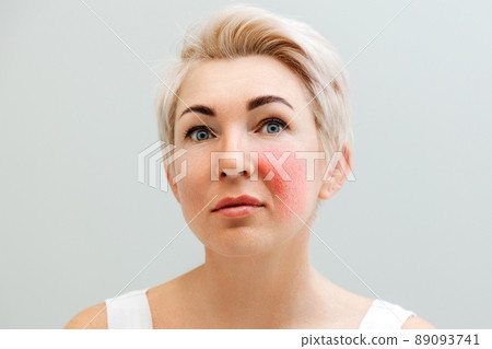 Portrait of caucasian adult beautiful woman with inflammation on her cheek. The concept of rosacea and aesthetic medicine 89093741
