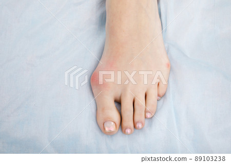 The woman suffers from inflammation of the big toe bone. Hallux valgus, bunion in foot on white background. 89103238