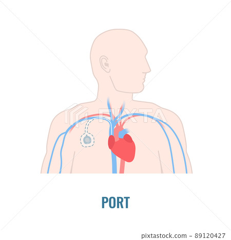 Implantable venous access port on male body 89120427