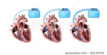 heart and cardiac pacemaker on white background 3d render, heart anatomy, section, right and left ventricle, atria, valves heart and cardiac pacemaker on white background 3d render, heart anatomy, section, right and left ventricle, atria, valves 89120495