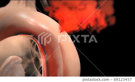 It may affect the left ventricle, aorta, aortic valve, or mitral valve. It may affect the left ventricle, aorta, aortic valve, or mitral valve. 89123457