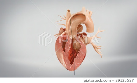Coronary reimplantation in ascending aortic aneurysm Coronary reimplantation in ascending aortic aneurysm 89123557