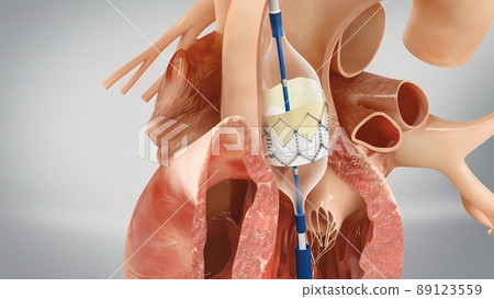 Coronary reimplantation in ascending aortic aneurysm Coronary reimplantation in ascending aortic aneurysm 89123559