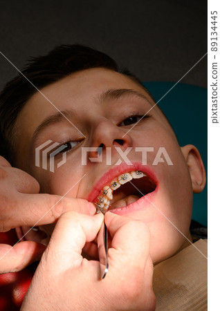 An orthodontist glues and fastens braces on the upper teeth of a schoolboy, aligning teeth with braces. 89134445