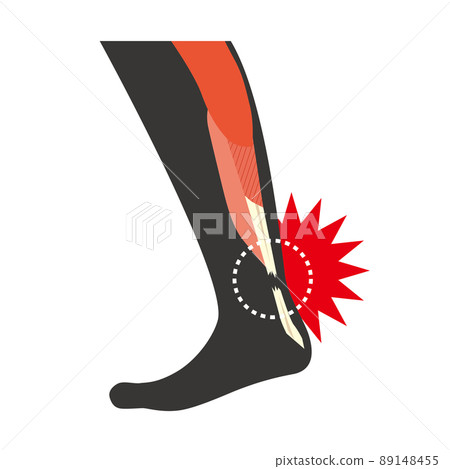 Achilles tendon rupture 89148455