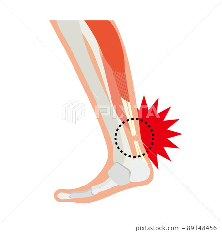 Achilles tendon rupture 89148456
