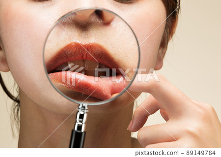 Spread mouth ulcer with a loupe. Spread mouth ulcer with a loupe. 89149784