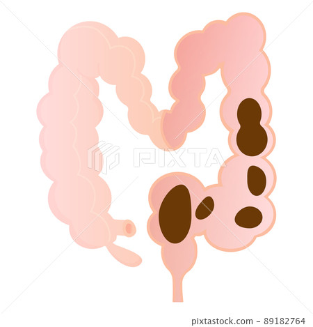 Vector illustration of flaccid constipation. Vector illustration of flaccid constipation. 89182764