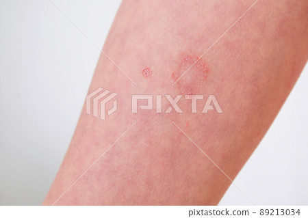The child has allergic contact dermatitis on the skin. The child has allergic contact dermatitis on the skin. 89213034