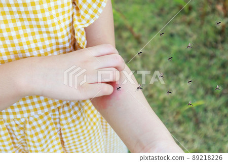 Little girl has skin rash allergy and itchy on her arm from mosquito bite 89218226